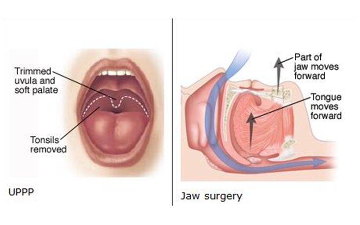 Surgery to Cure Snoring